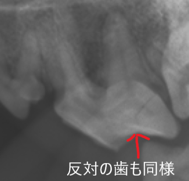 右上第4前臼歯.png
