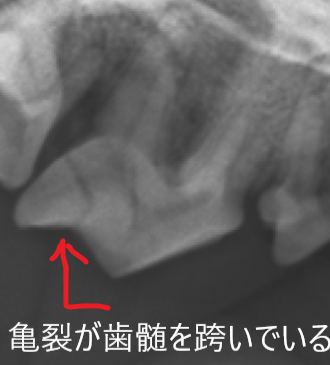 左上第4前臼歯.png